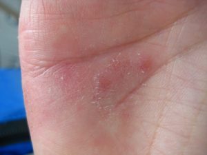 allergy symptom dermatitis