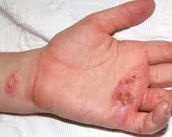 eczema, Skin inflammation, Allergic dermatitis