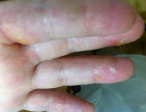 .Dermatitis allergy trigger