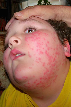 allergic-reaction - Manage Allergies